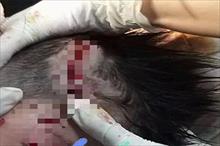 Bé trai 4 tuổi ở Hà Tĩnh bị chó béc giê nhà lao vào cắn xé
